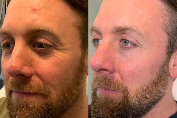 Chemical Peels at Shri Aesthetics