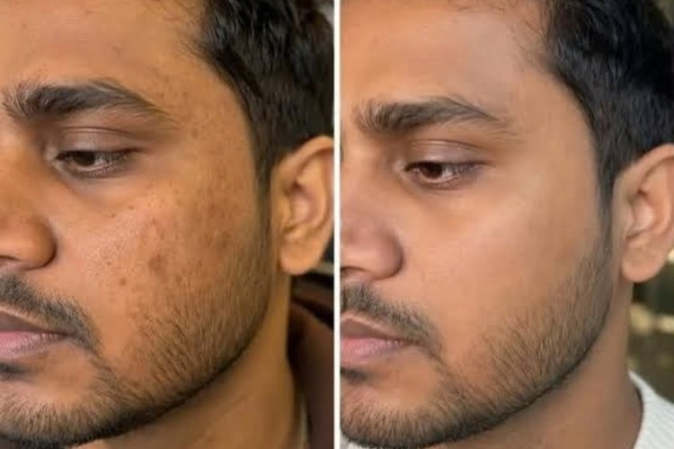 Pigmentation Treatment Options