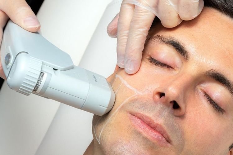 Skin Tightening Treatment at Shri Aesthetics