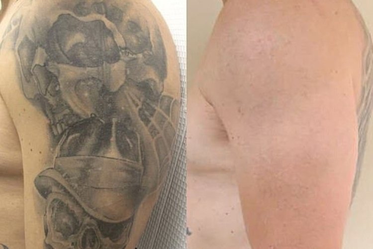 Tattoo Removal Treatment Journey