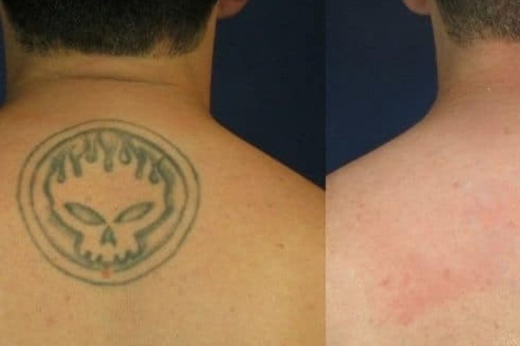 Tattoo Removal at Shri Aesthetics